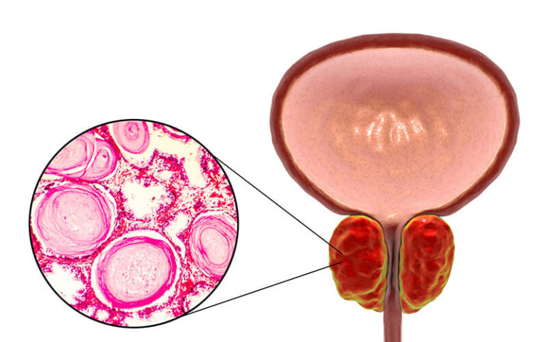 Tratamento para Hiperplasia Prostática Benigna (HPB)