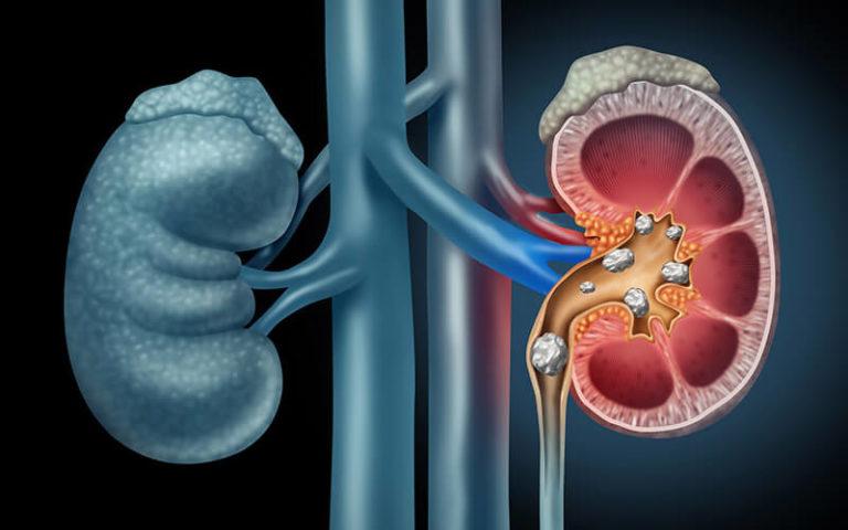 Tratamento para Litíase Renal